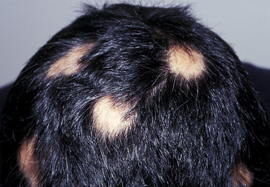 Perte de Cheveux - Alopécie Circonscrite - Om Signature Clinique Médico-Esthétique